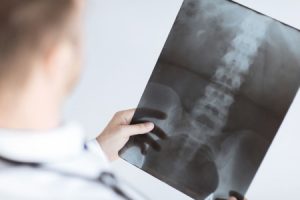 Broken back and slipped disc compensation