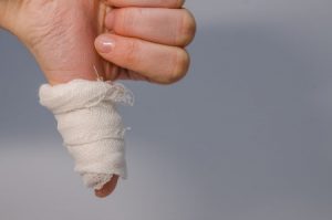 Severe dislocation of thumb compensation