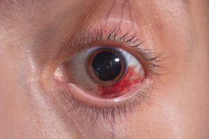 Eye injury caused by welding compensation