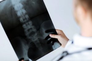 Fractured/Broken Coxxyx/Tailbone compensation