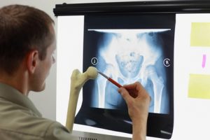 Fractured pelvis compensation