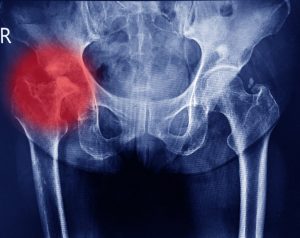 average compensation for broken hip