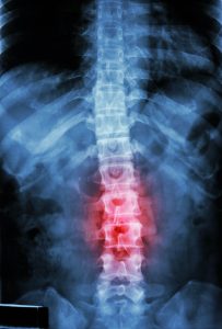 Serious Spine Injury Claim