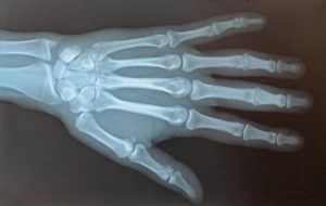 An X-Ray of a hand showing the different bones