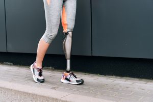 Woman with prosthetic leg who received leg amputation compensation. 
