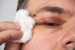A man has a black eye and now has reduced vision and might suffer total blindness in the one eye at a later date. He's thinking of looking into eye injury claims.