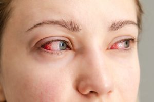 A woman has really red eyes because she is now severely sight impaired and will continue to experience significant sight loss. She's thinking of looking into sight compensation claims.