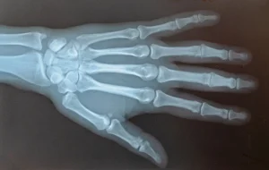 An X-ray of a person's left hand.