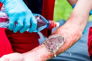 A person receives treatment for a burn injury.